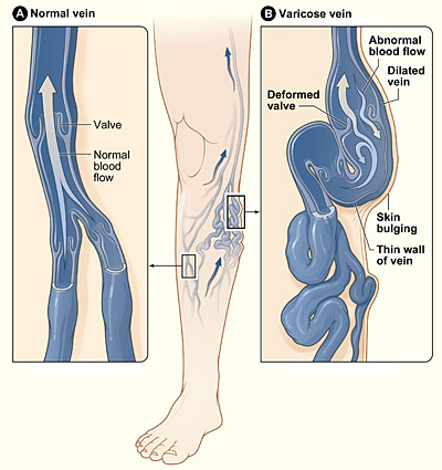 Laser for Varicose Veins Rental Service in India